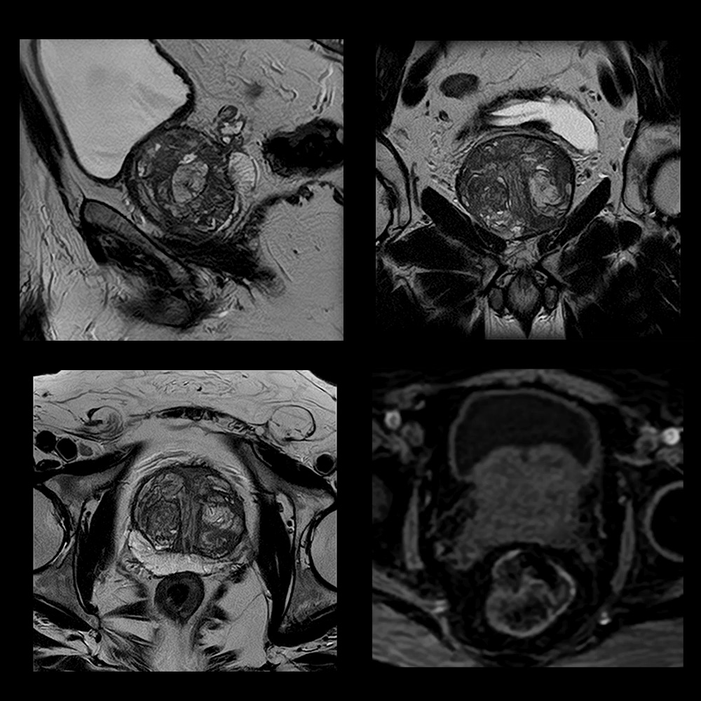 Routine Prostate Imaging with AiCE