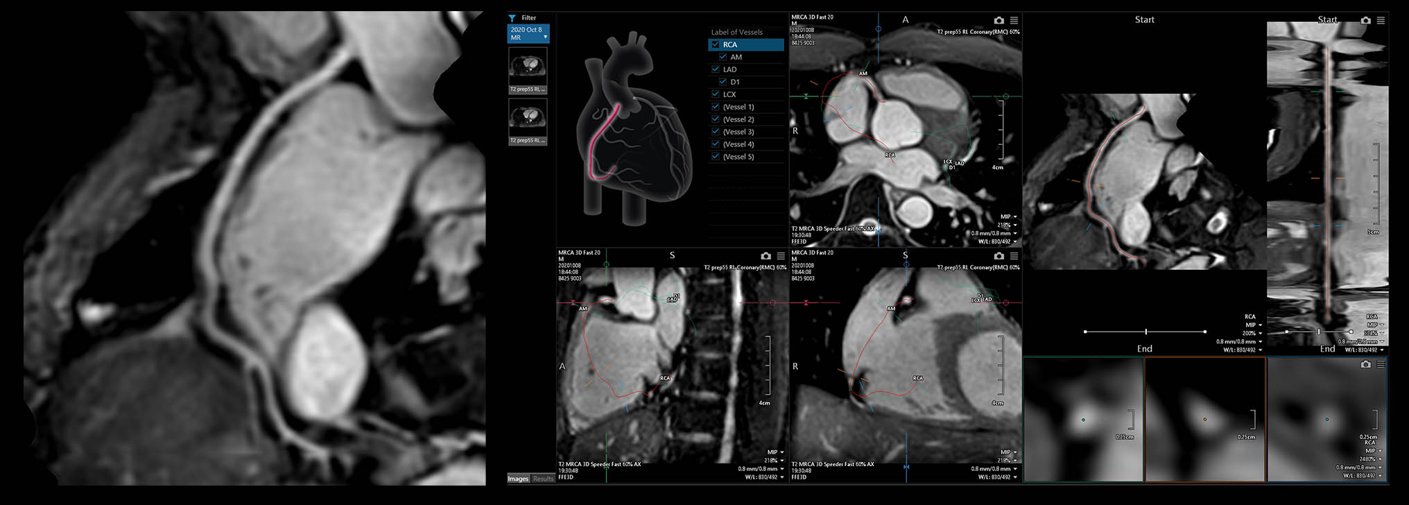 MR Coronary Artery Imaging with Fast 3D