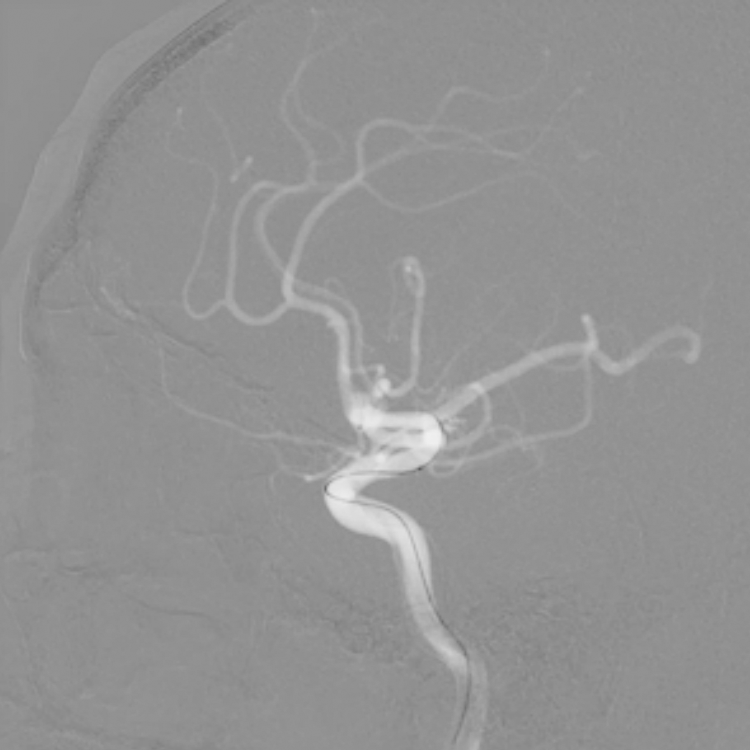 Infinix I Technology Angiography Canon Medical Systems USA