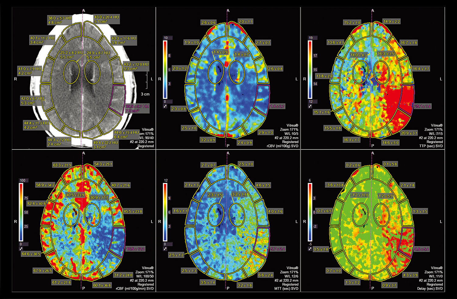 CT Brain Perfusion 2D