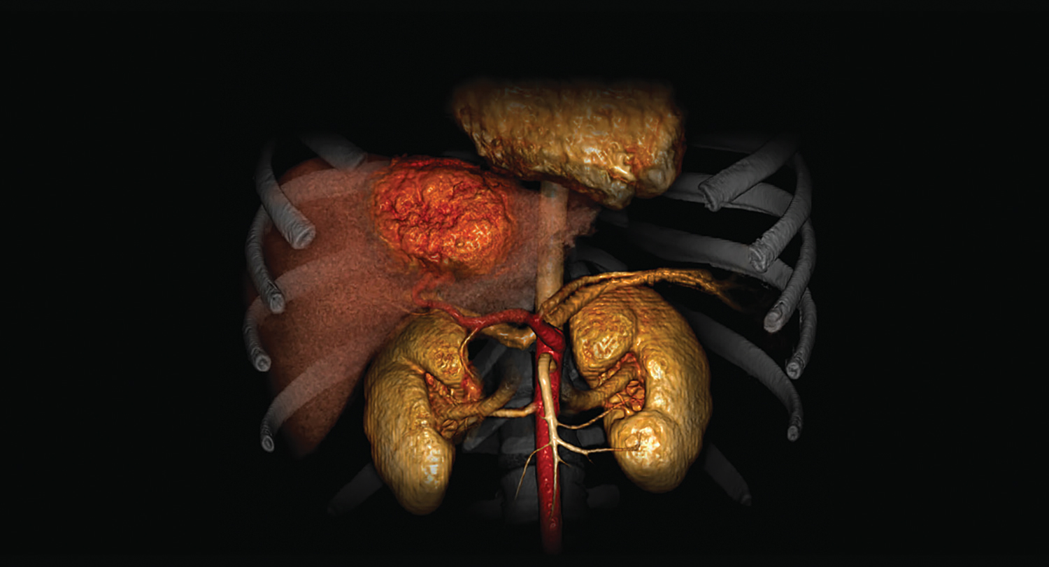 CT Liver Analysis