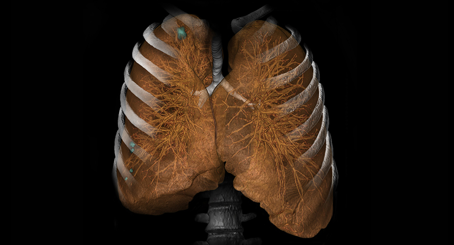 CT Lung Analysis