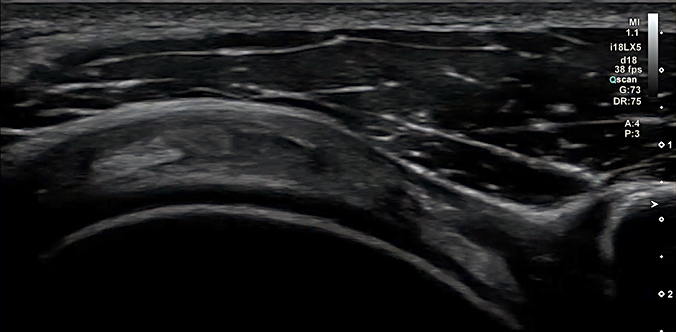 Shoulder Ultrasound