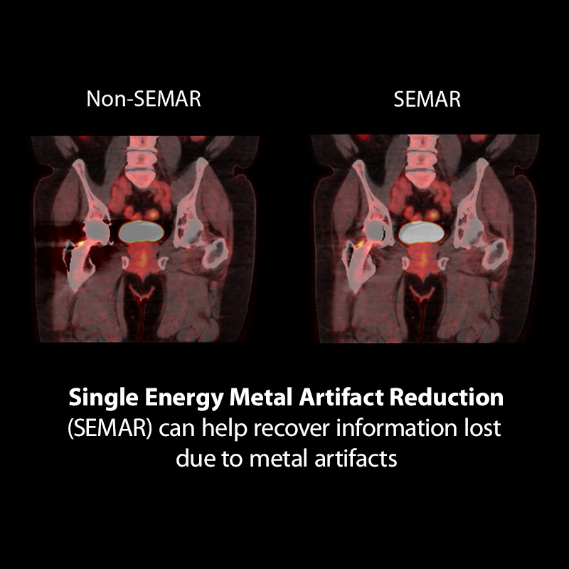 Single Energy Metal Artifact Reduction (SEMAR) can help recover information lost due to metal artifacts