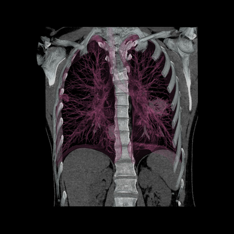 FIRST, Multiple Lung Tumors