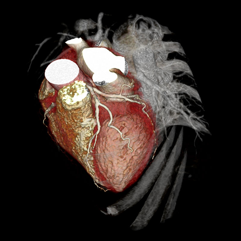 FIRST, LAD Calcified Plaques