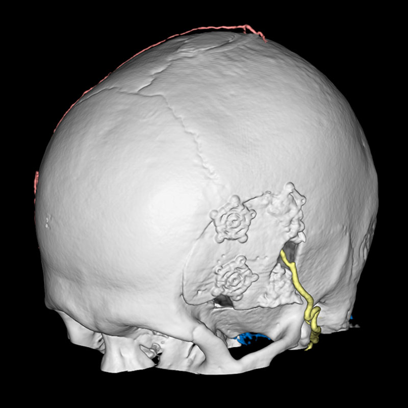 4DCT DSA, Cerebral Bypass