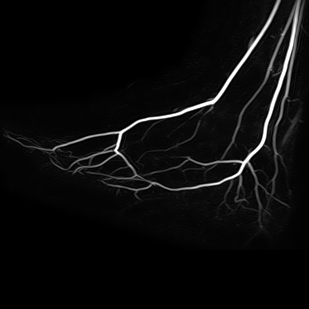 MR Angiography of the Foot