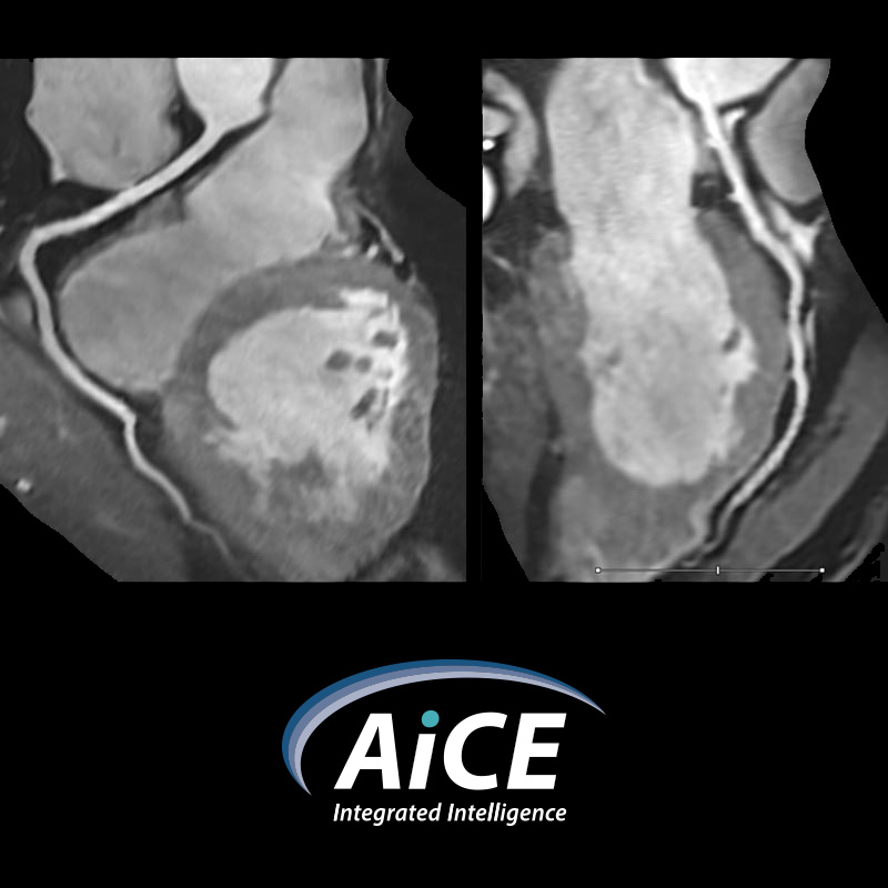 AiCE applied to expanded body regions Non-Contrast MRCA (Fast3D)