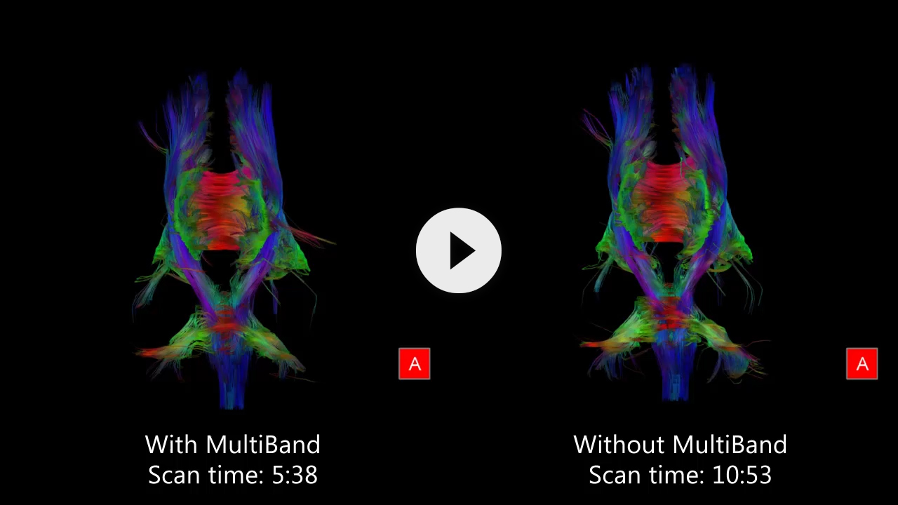 48-Direction Diffusion Tensor Imaging<