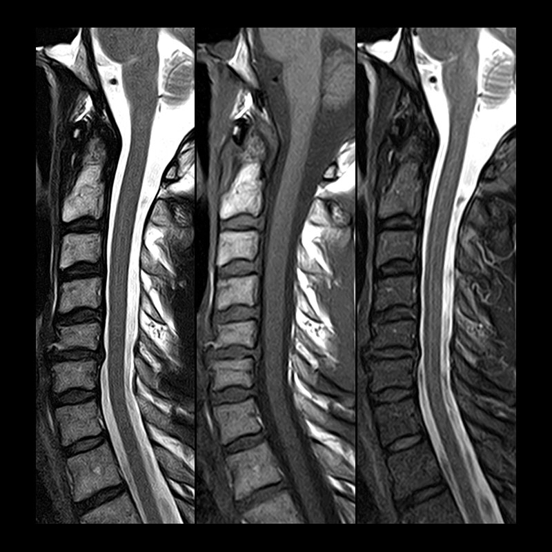 Cervical Spine