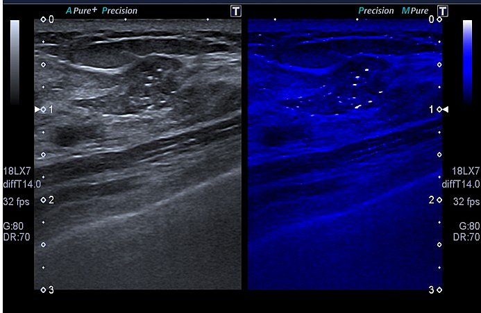 MicroPure Multi-Calcifications