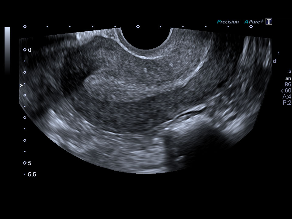 OB/GYN | Clinical Gallery | Aplio Platinum Series | Ultrasound ...