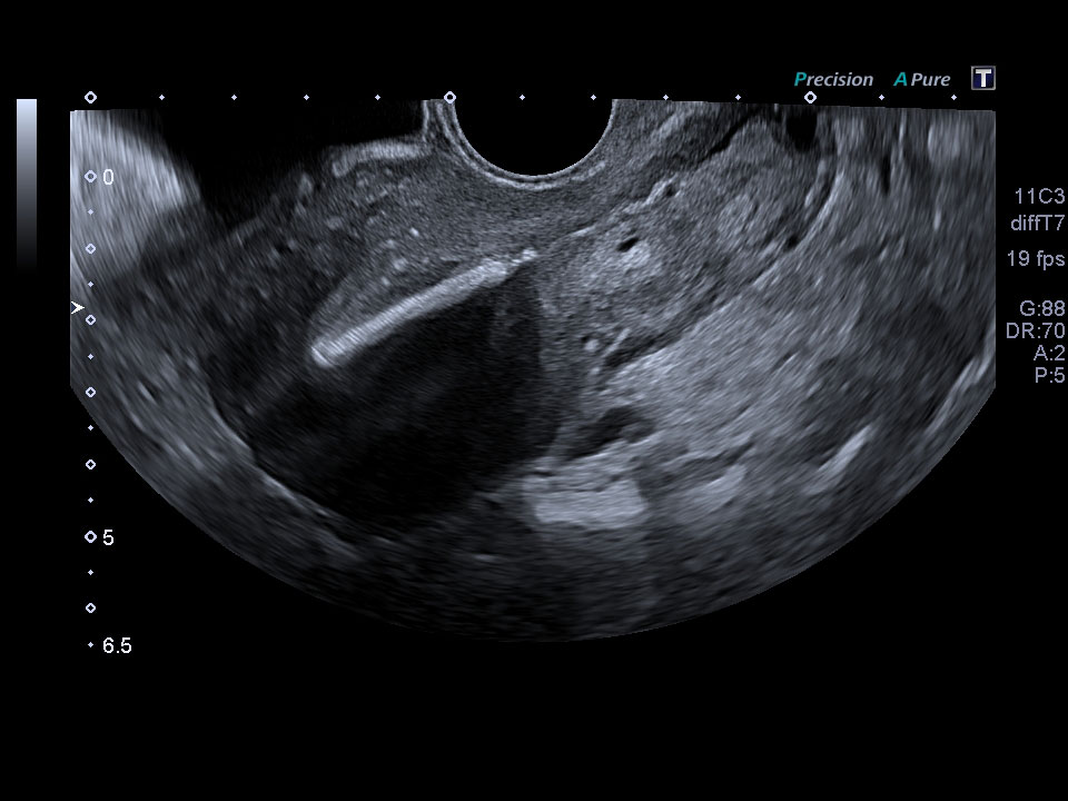 OB/GYN | Clinical Gallery | Aplio Platinum Series | Ultrasound ...