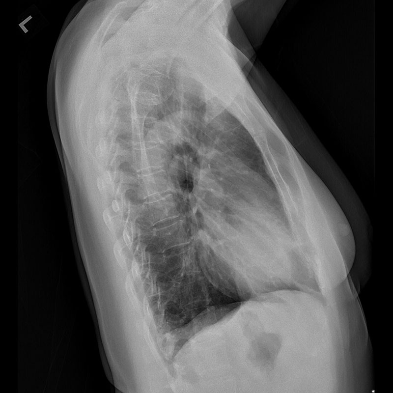 Chest X-ray, Female