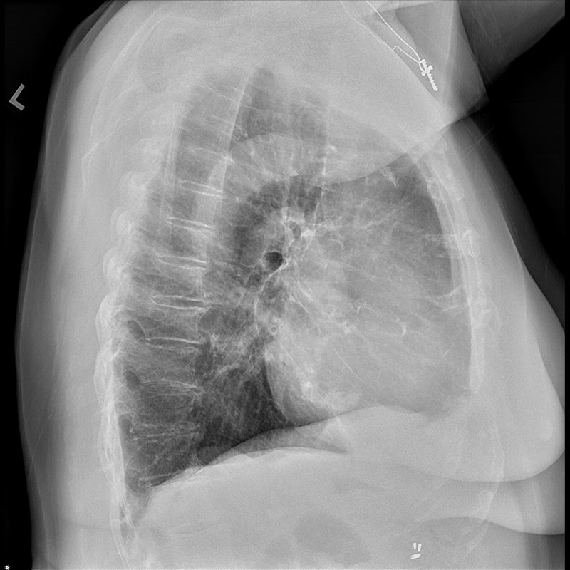 Chest X-ray, Female