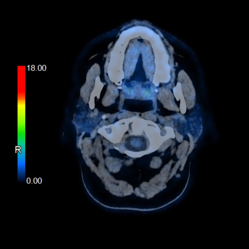 Brain, Anaplastic Oligodendroglioma