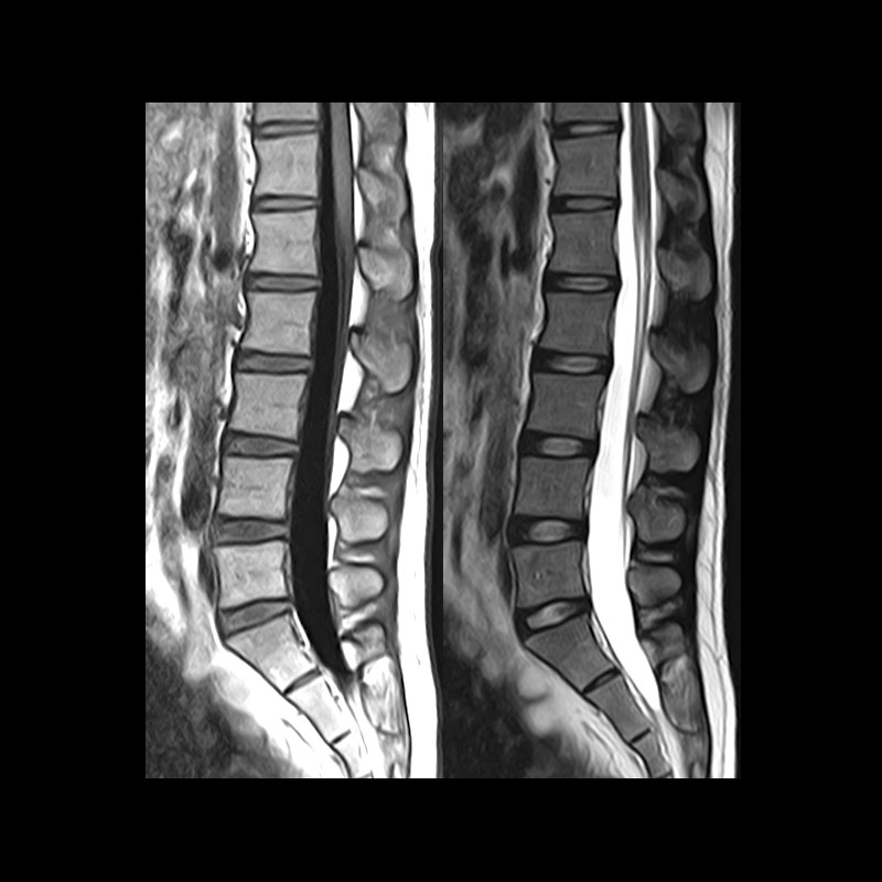 Lumbar Spine Myelogram