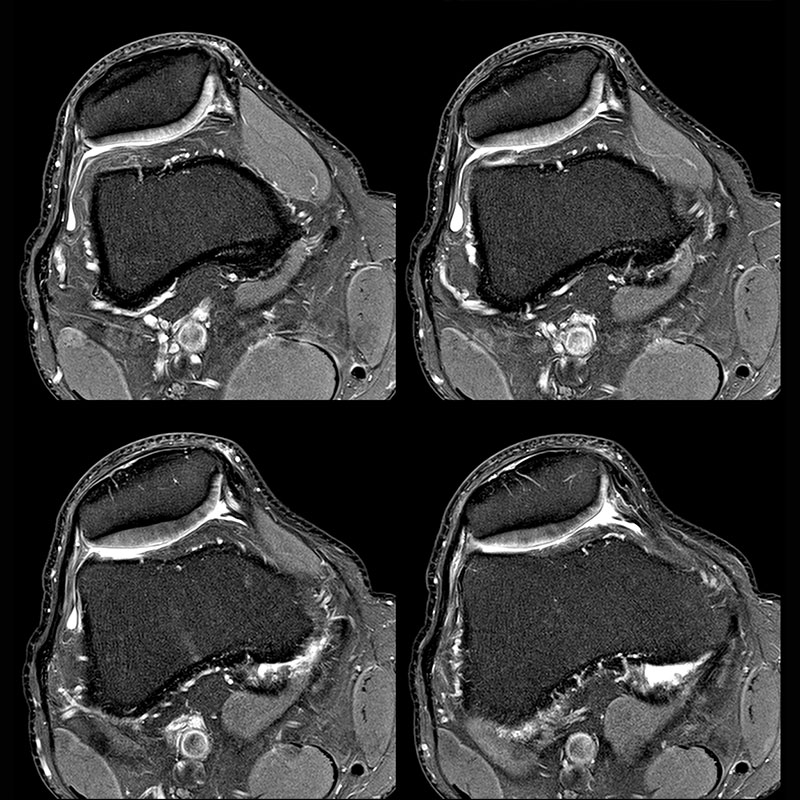 Orthopedic Lower Knee