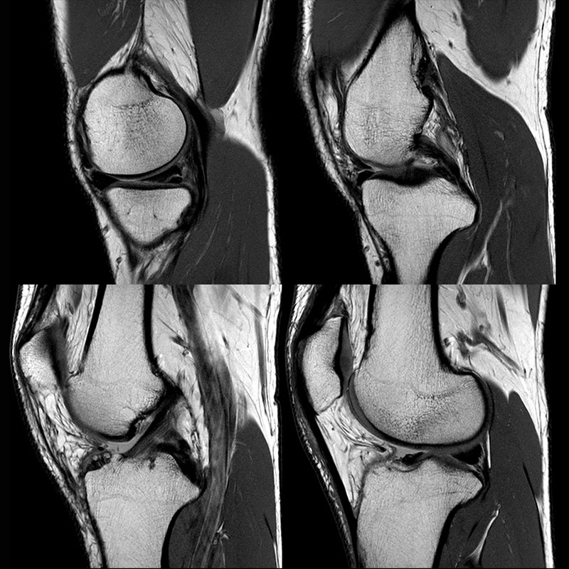 Orthopedic Lower Knee