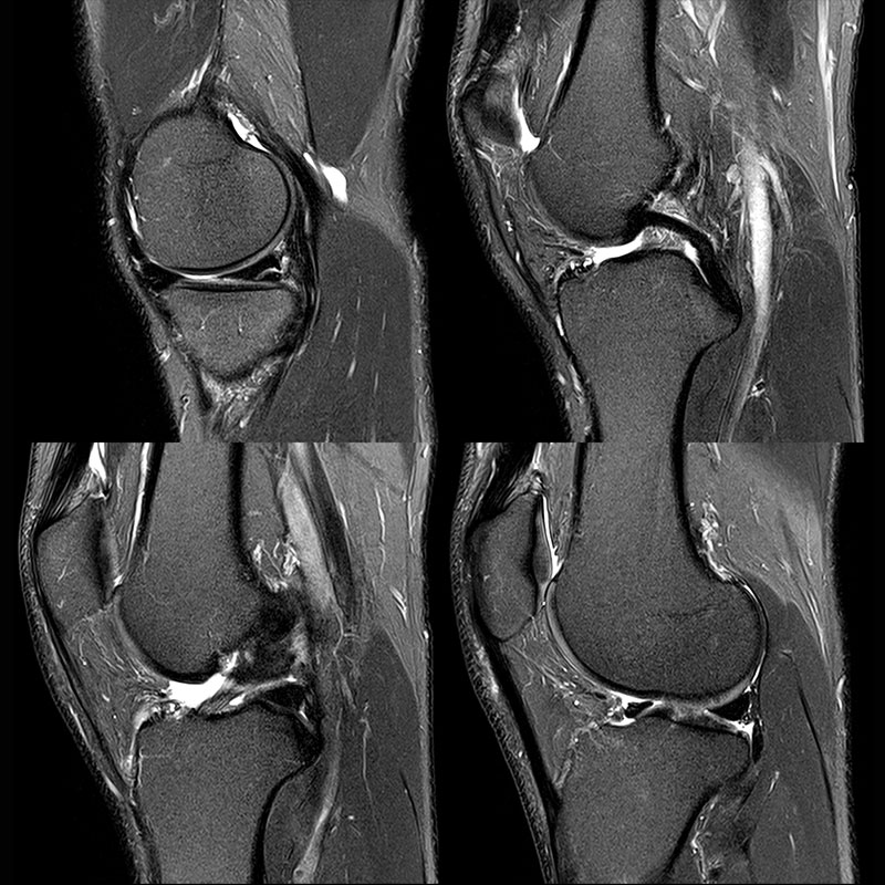 Orthopedic Lower Knee