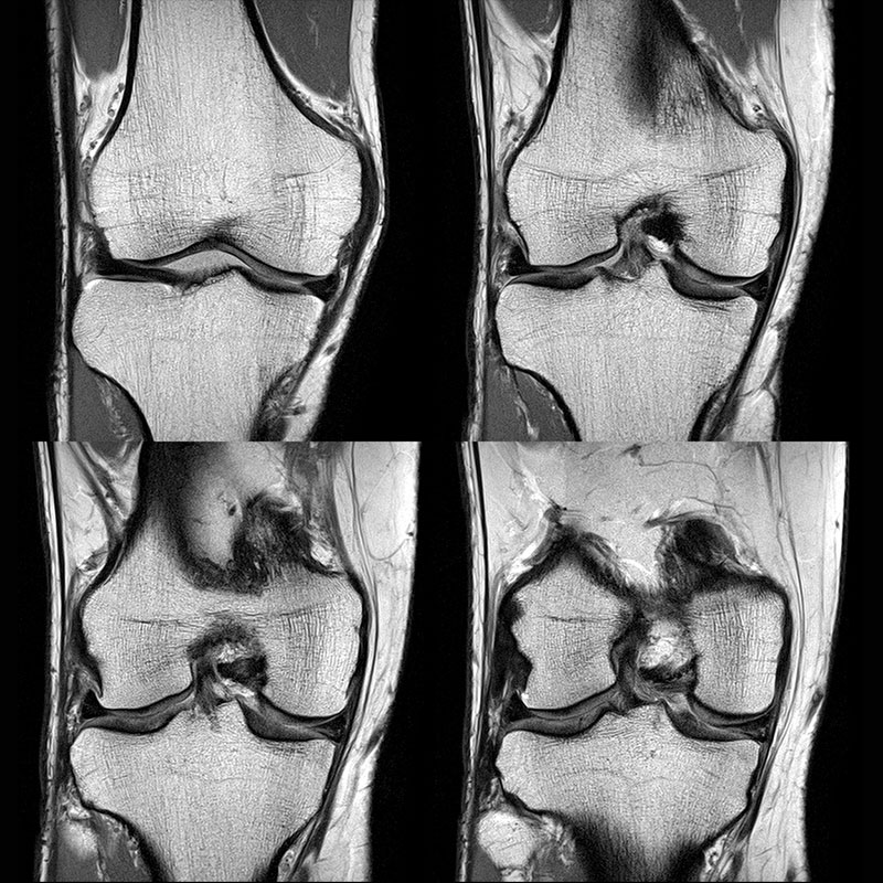 Orthopedic Lower Knee