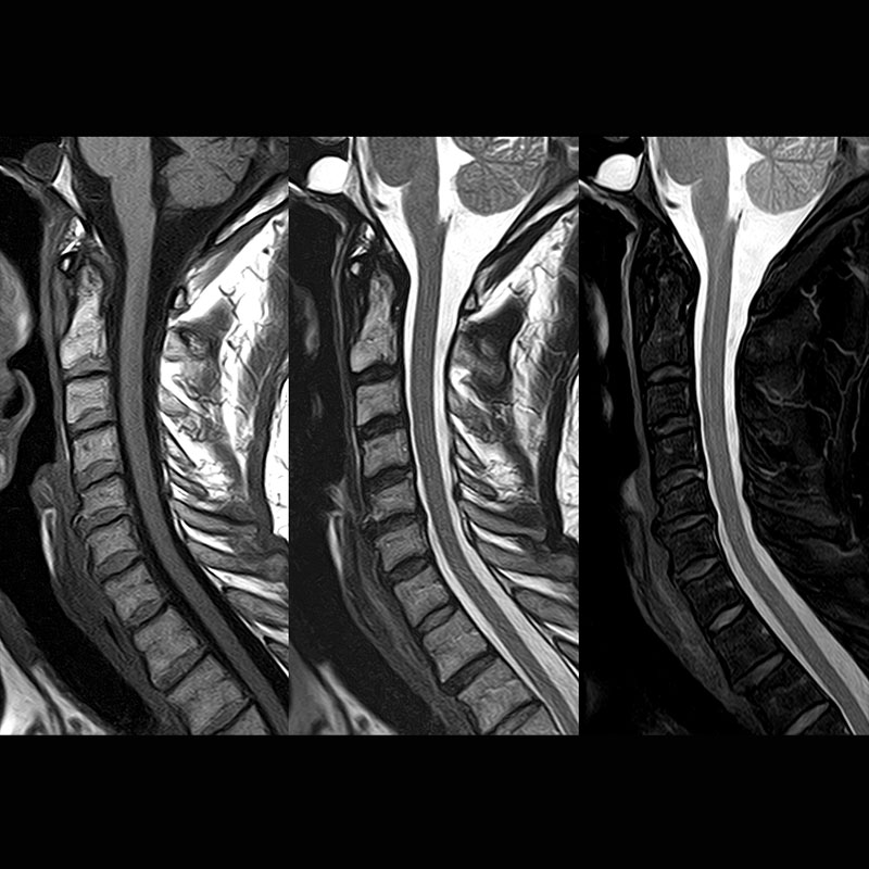 Cervical Spine