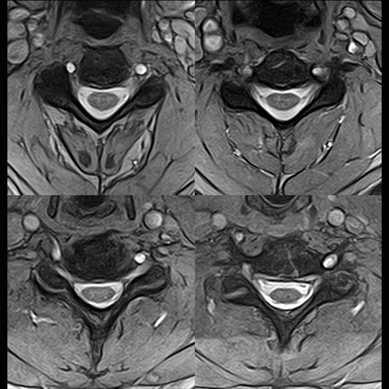 Cervical Spine