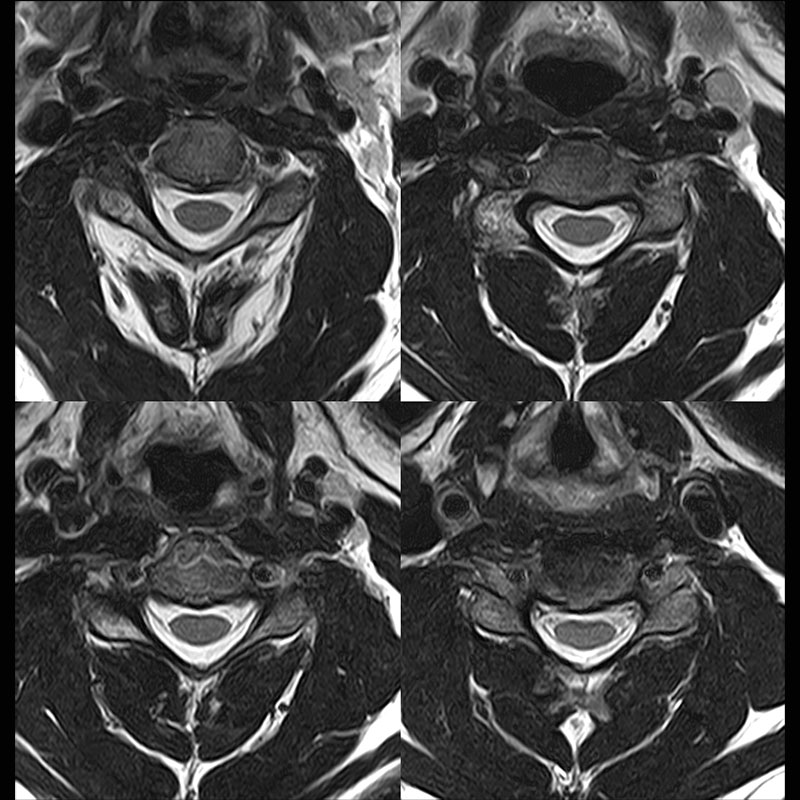 Cervical Spine