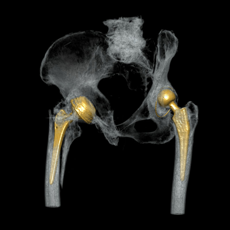 Bilateral Hip Replacement