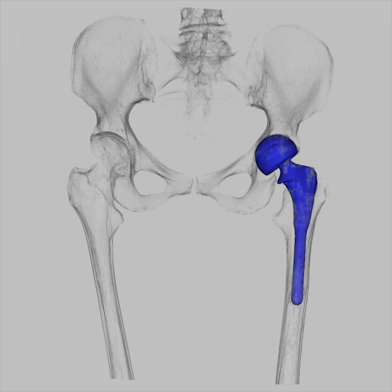 Left Hip Replacement