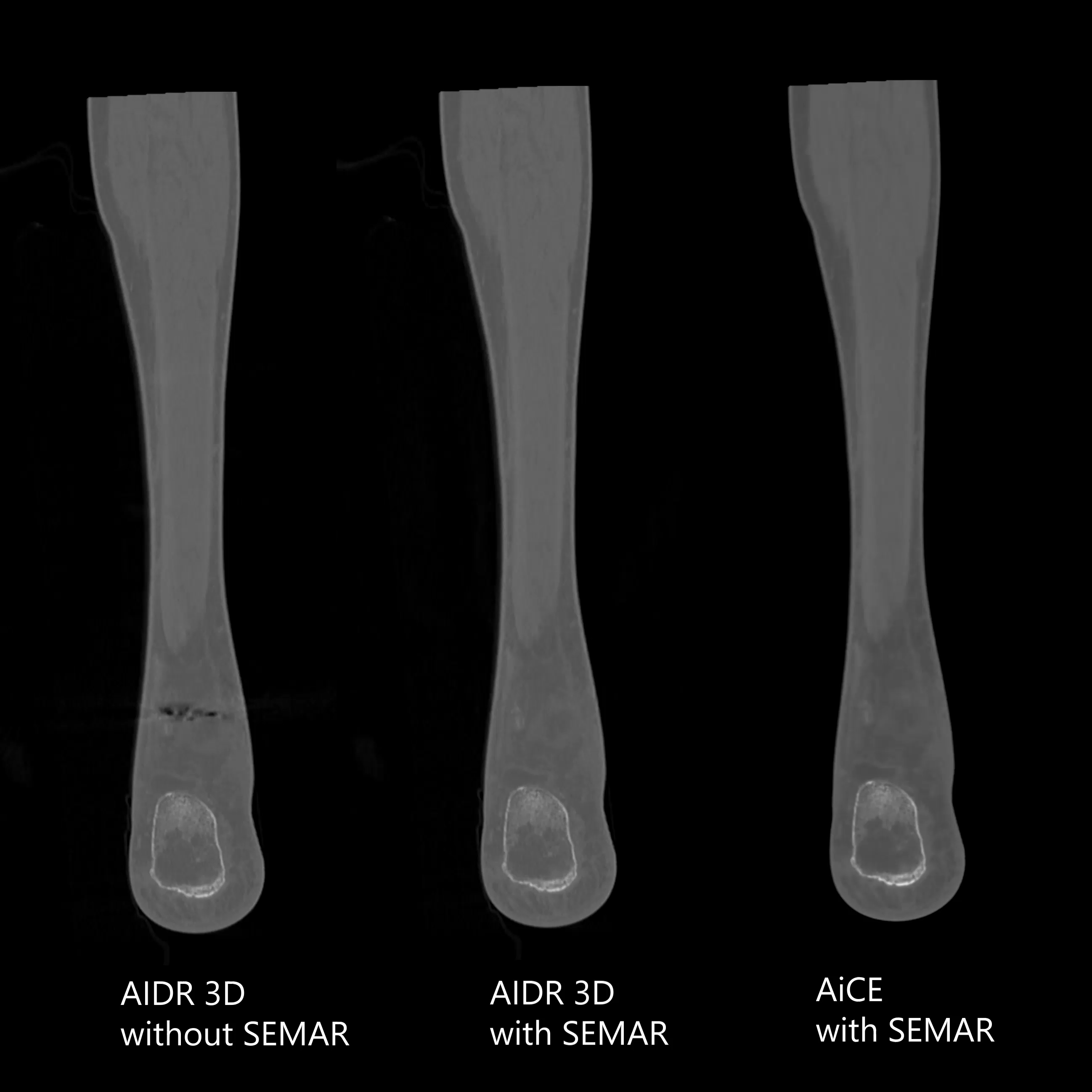 Ankle Fracture Fixation, AiCE, SEMAR