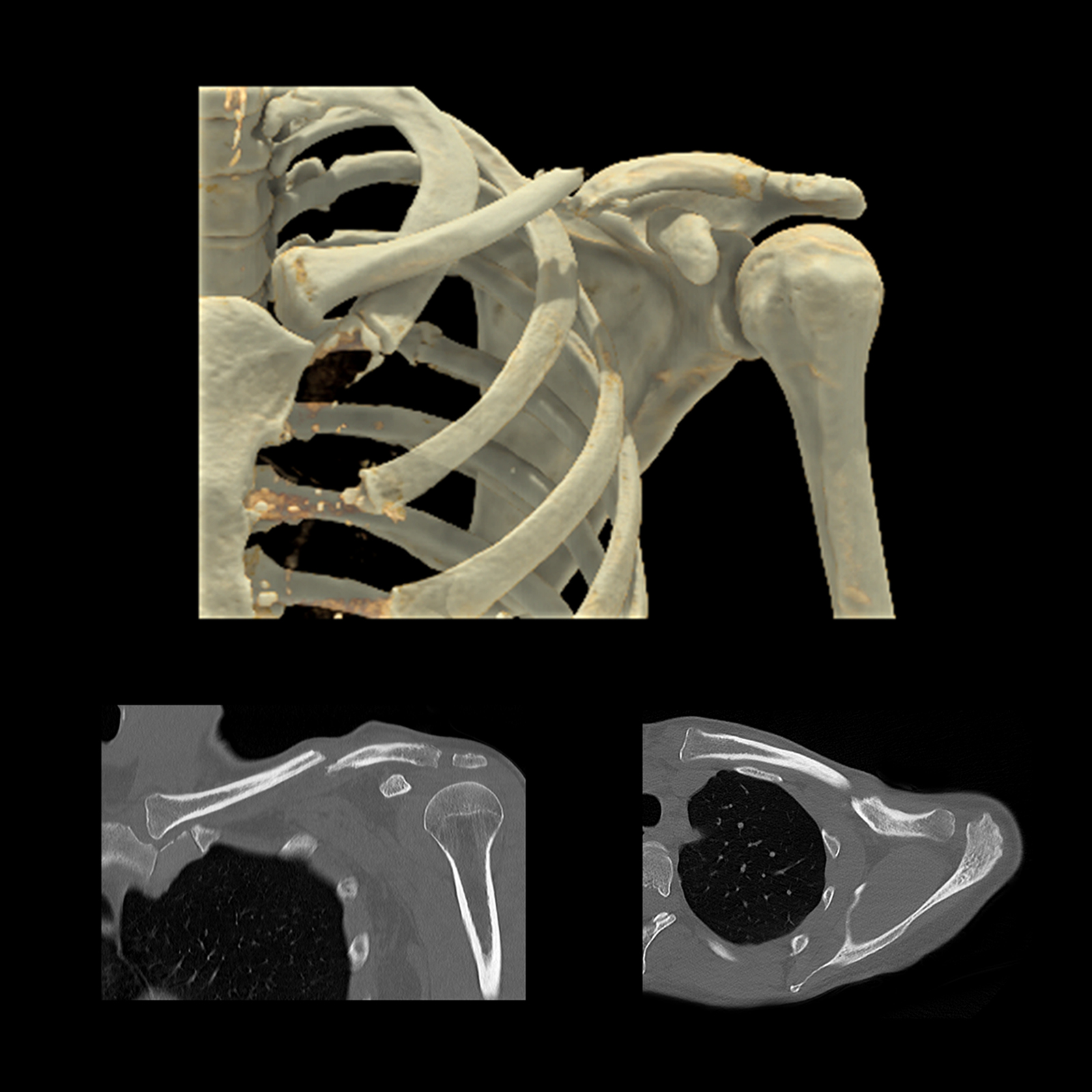 Clavicle Non-united Fracture, AiCE