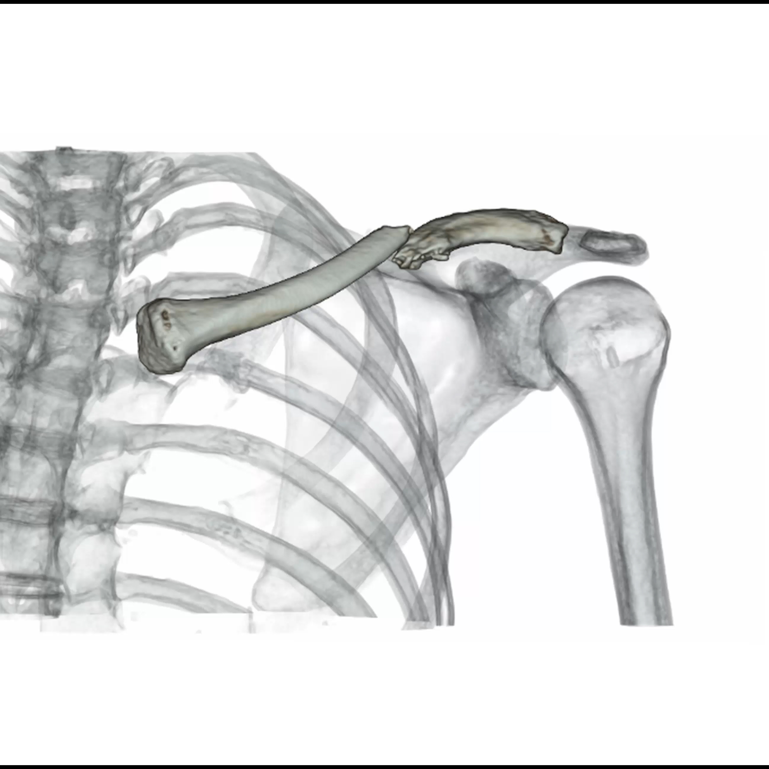 Clavicle Non-united Fracture, AiCE