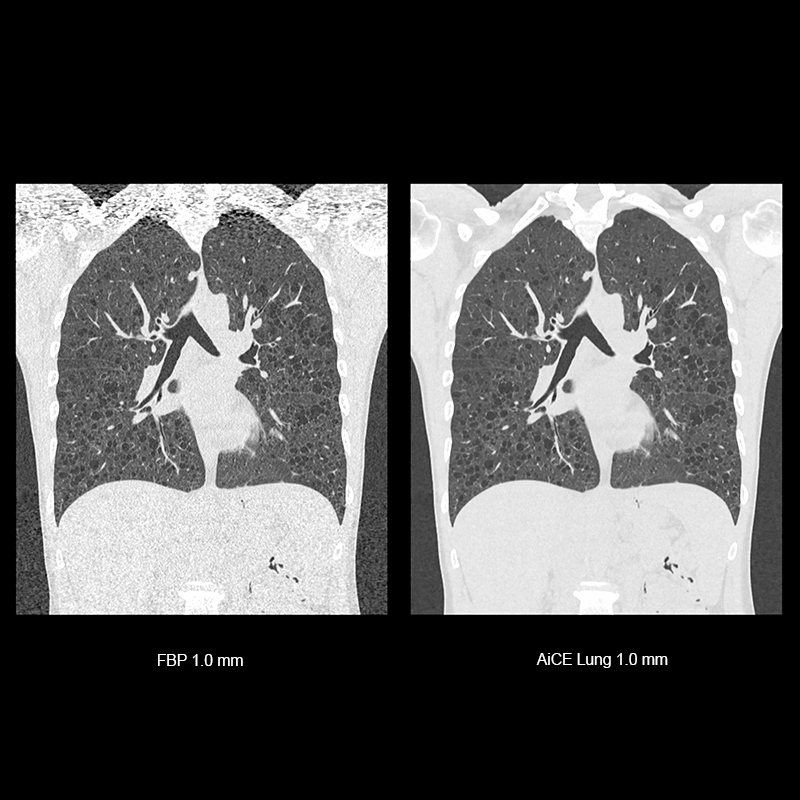 Lung LAM Disease, AiCE