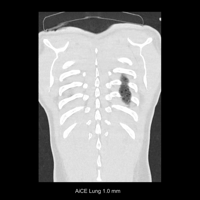 Lung LAM Disease, AiCE
