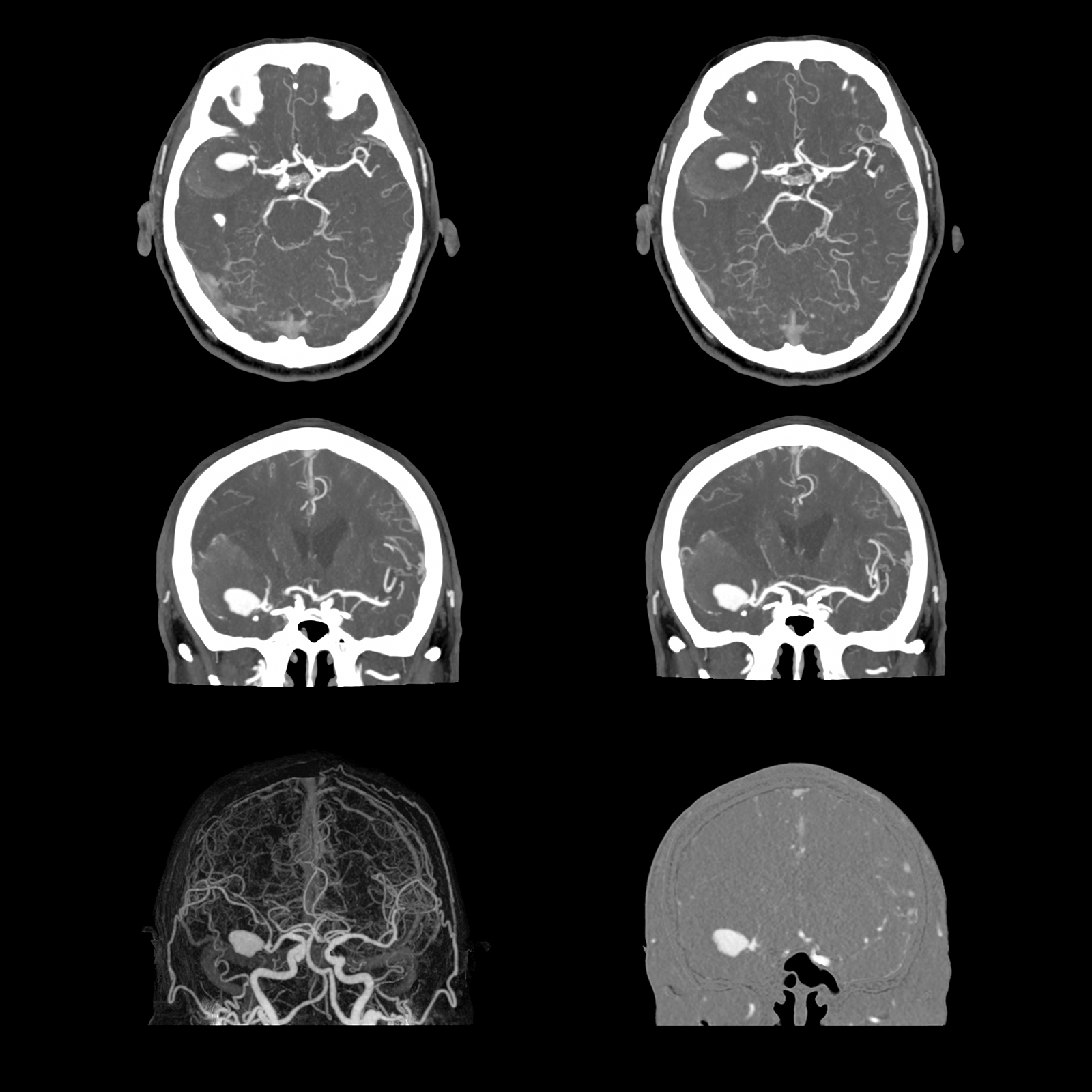 Brain CTA Right MCA Aneurysm, SURESubtraction