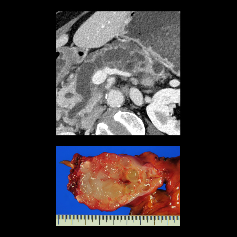 AiCE, SHR, Mixed-type Pancreatic Cancer