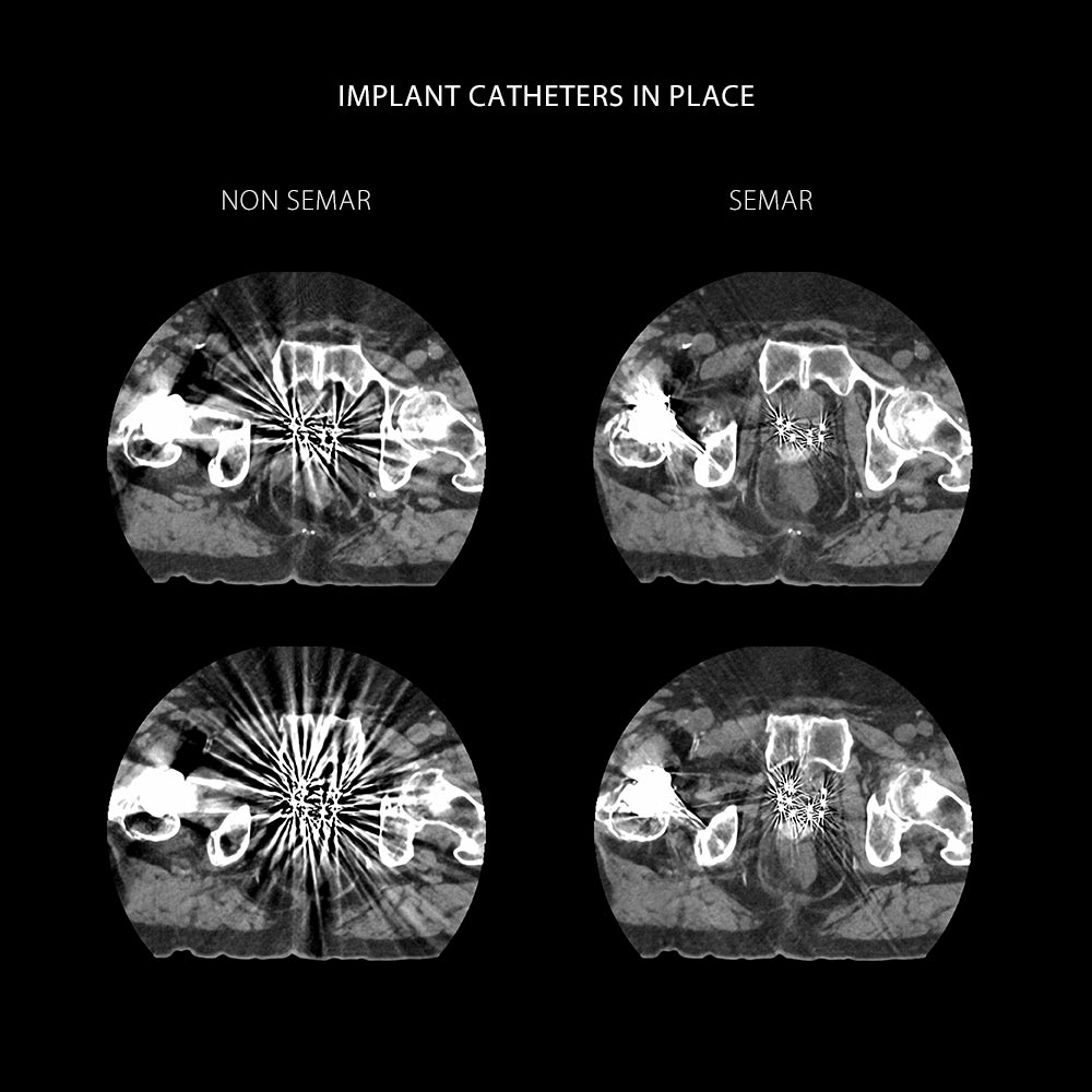 Prostate Cancer CT Simulation HDR Brachytherapy, AiCE, SEMAR