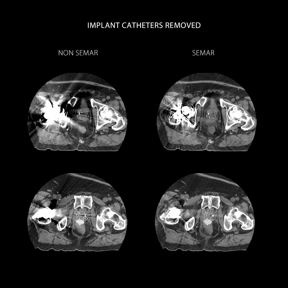 Prostate Cancer CT Simulation HDR Brachytherapy, AiCE, SEMAR