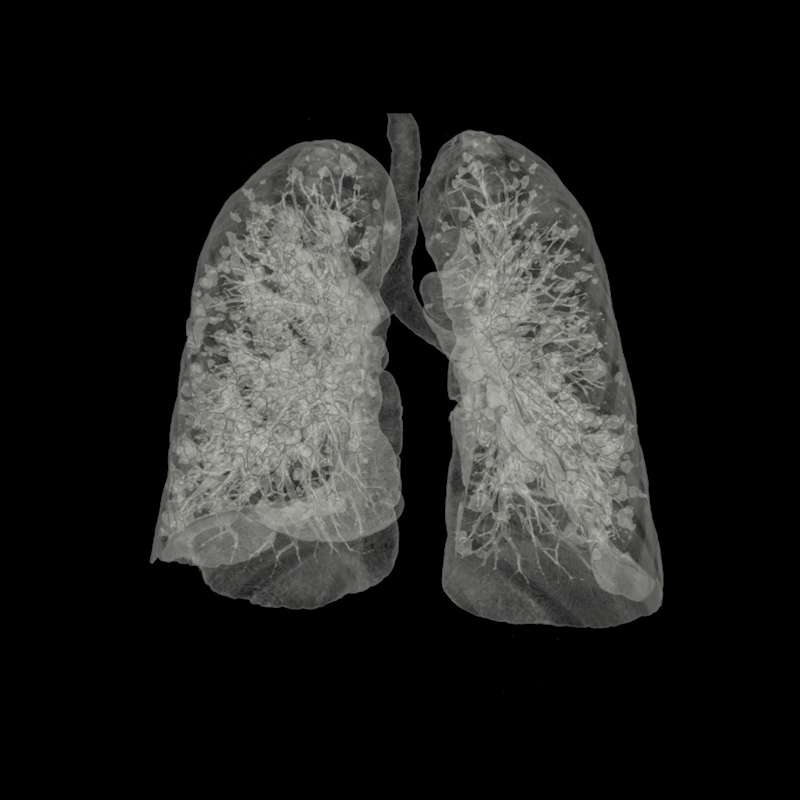 Lung Metastasis