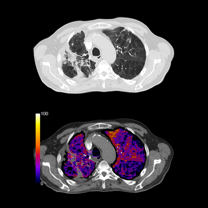 Lung COPD, SURESubtraction