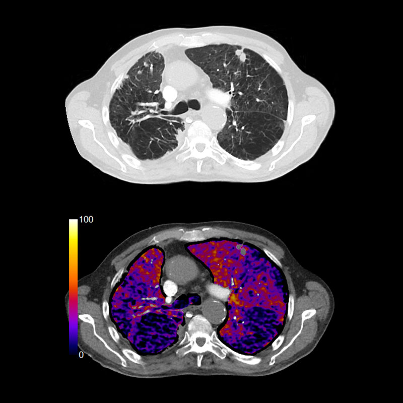Lung COPD, SURESubtraction