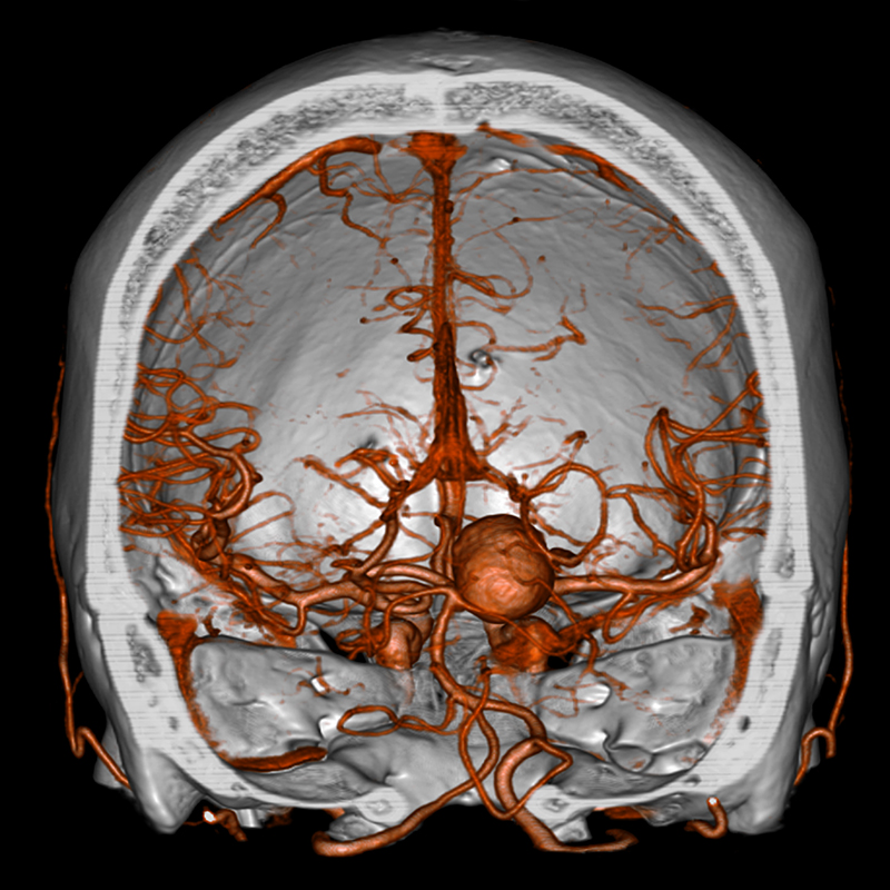 Brain Cerebral Aneurysm, SURESubtraction