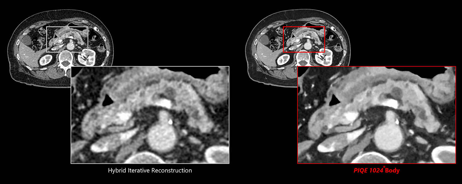 Pancreas – Body Super Resolution