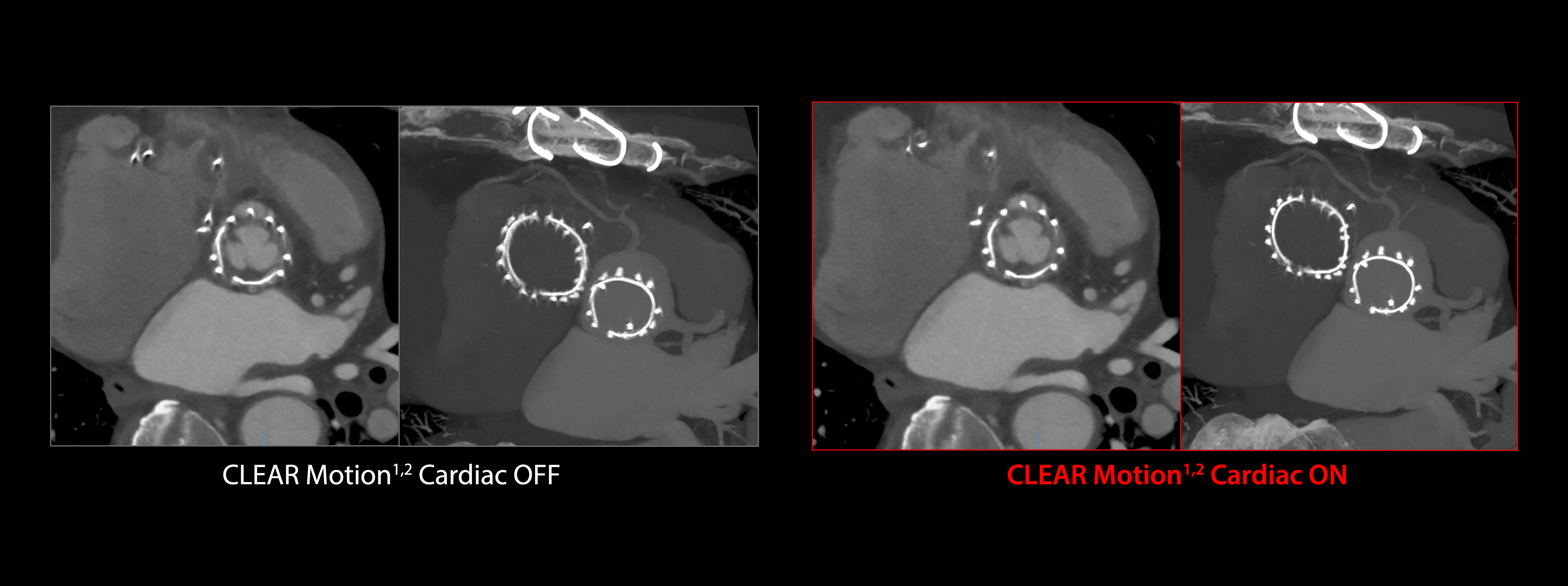 CLEAR Motion: Aortic and Mitral Valve Replacements