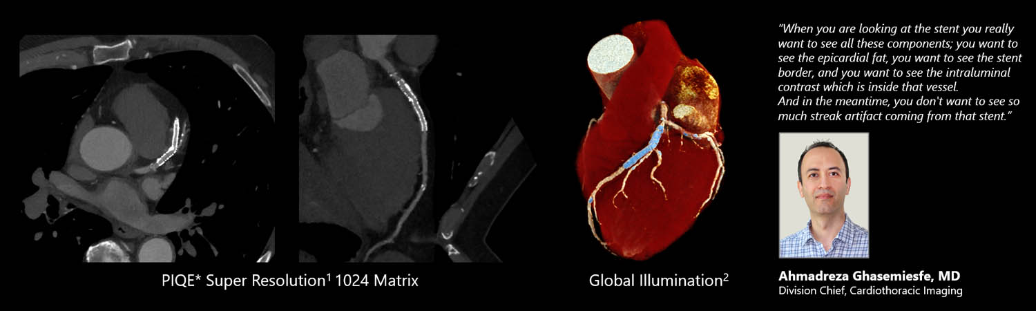 LAD Stent with PIQE 1024