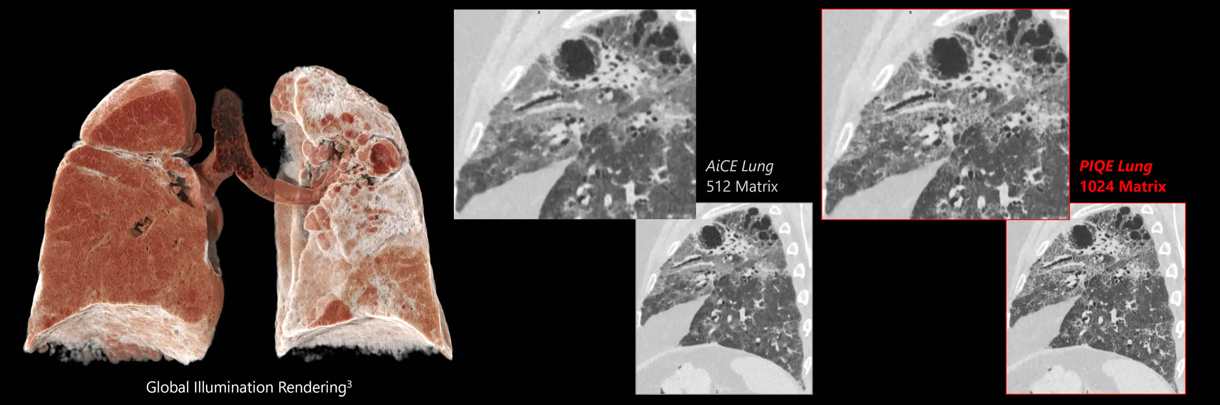 Adenocarcinoma with PIQE Lung1 and SilverBeam Filter