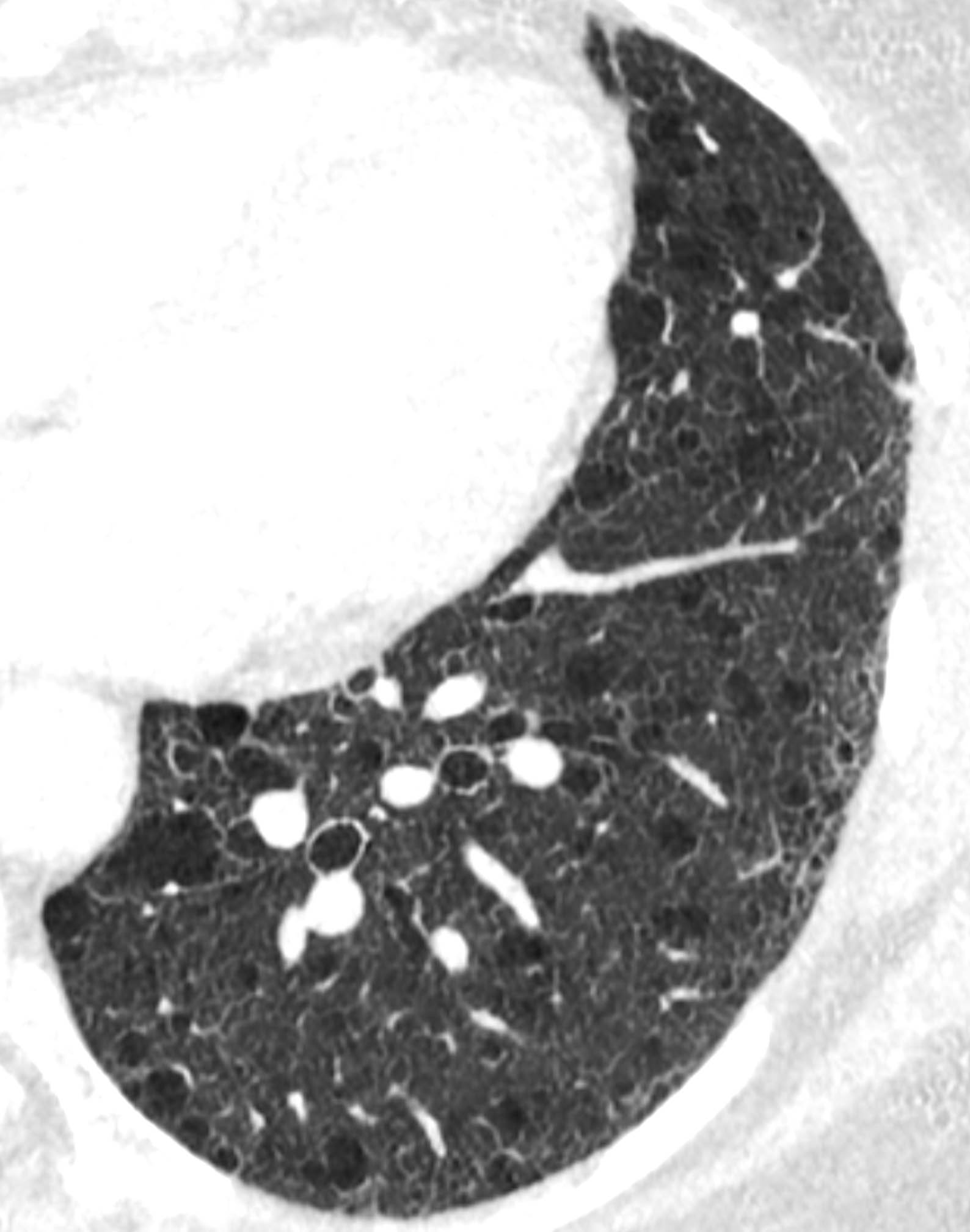 CLEAR Motion Lung