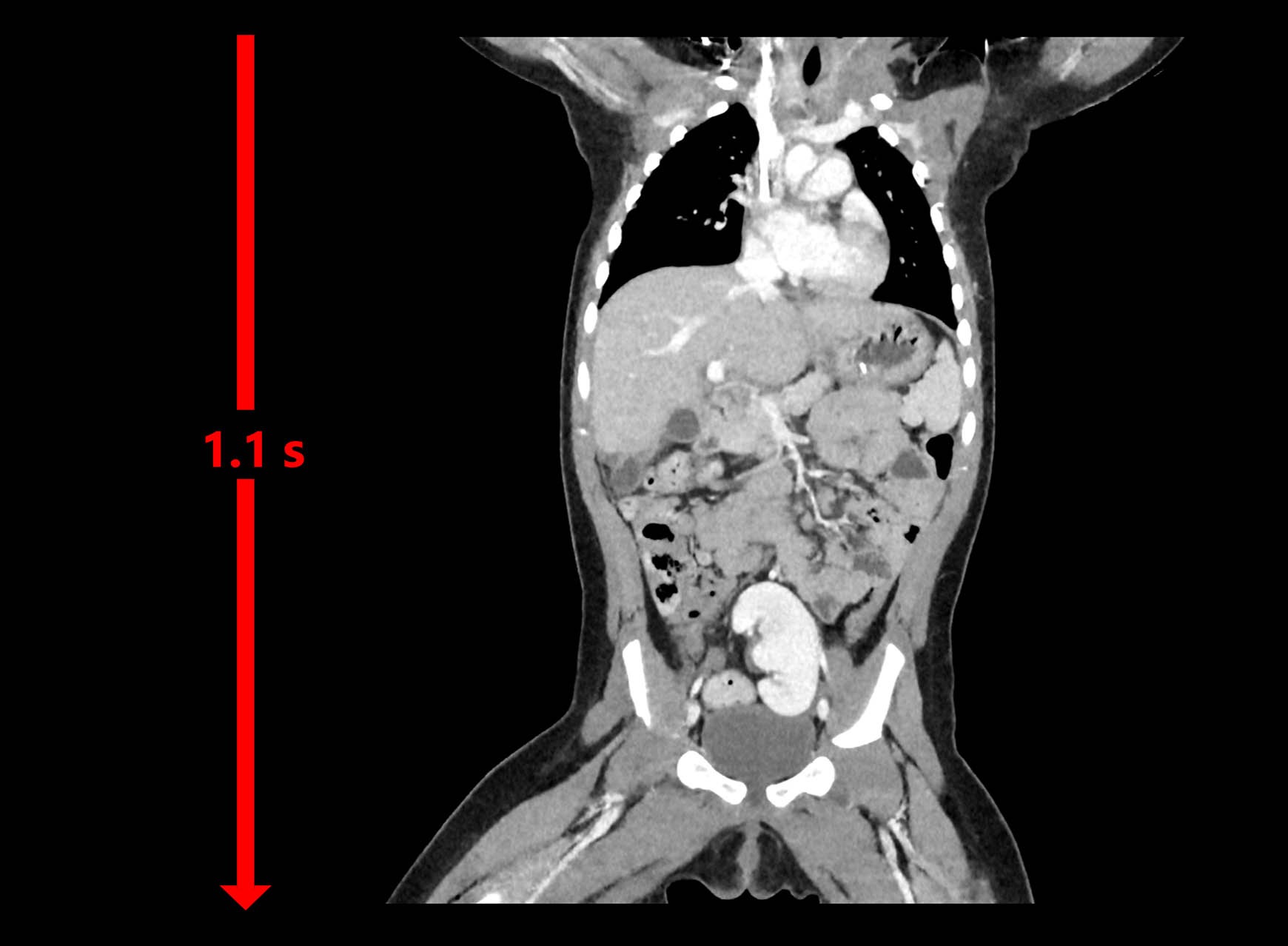 11 month old - Turbo Helical CAP